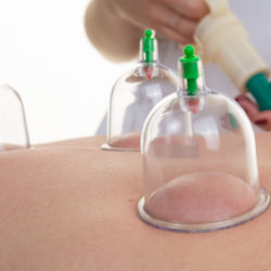 Acupuncture Therapist Placing Cup On The Back Of A Female Patient